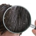 Examiming white dandruff flakes in hair with magnifying glass.