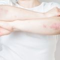 Acute psoriasis on elbows is an autoimmune incurable dermatological skin disease. Large red, inflamed, flaky rash on the knees. Joints affected by psoriatic arthritis.