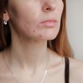 Woman with problem skin. Teen acne on young skin.