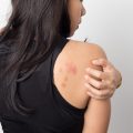 woman showing her skin itching behind , with allergy rash urticaria symptoms